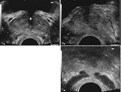 Transrectal Ultrasound Of Prostate – Telegraph