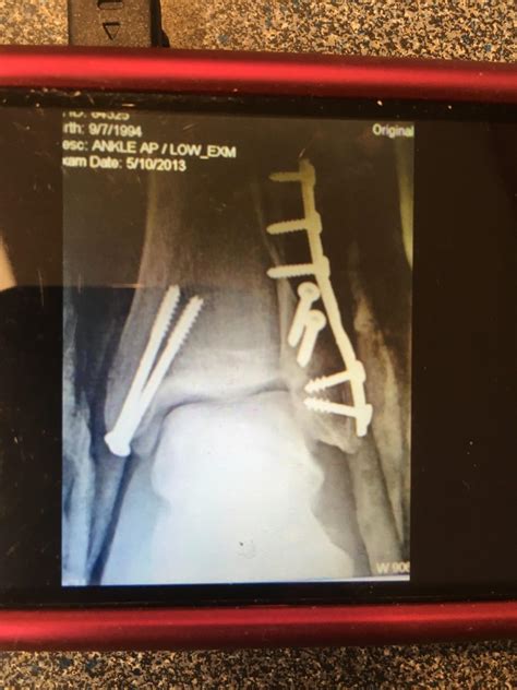 Bimalleolar left ankle fracture : XRayPorn