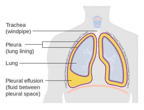 Pleural Effusion - You will be able to treat it as soon as possible