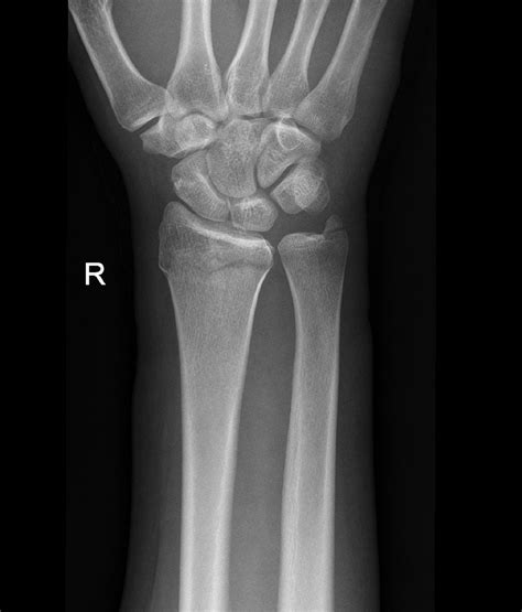 Ulnar Styloid Fracture Splint