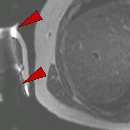 MRI Artifacts - susceptibility artifact - MR-TIP.com