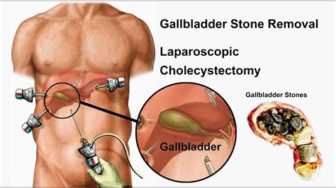 Gallbladder (Stone) Removal Surgery | Laparoscopic Cholecystectomy - YouTube