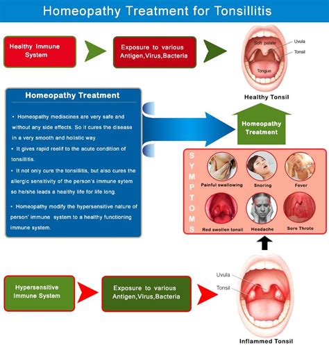 Tonsillitis Treatment