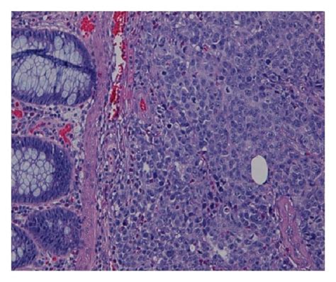 Sigmoid colon mass biopsy showing neoplastic proliferation of cells ...