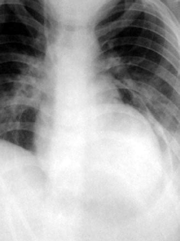 Pneumopericardium | Eurorad