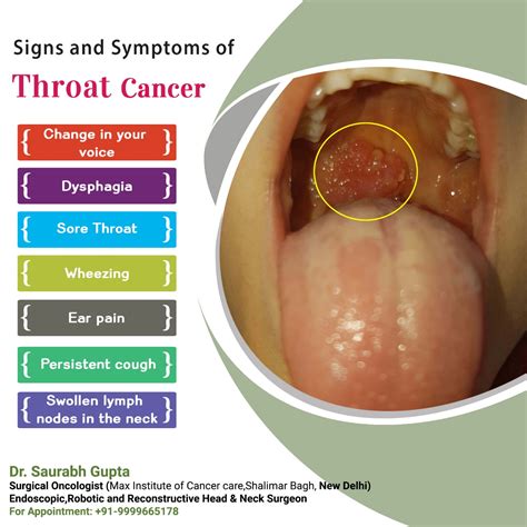 Dr. Saurabh Gupta Oncologist: Signs & Symptoms Of Throat Cancer