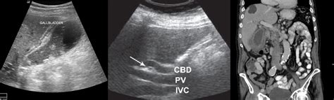 Biliary Infections and Complications | RECAPEM