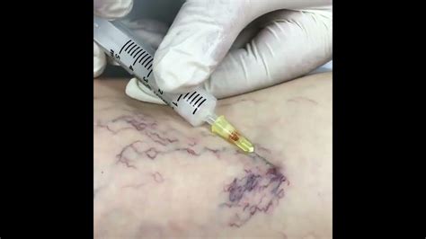 Injecting sclerosing agent in telangiectasia (dilated abnormal veins) # ...