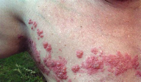 Shingles: The symptoms and treatment of the herpes zoster rash - Archyde