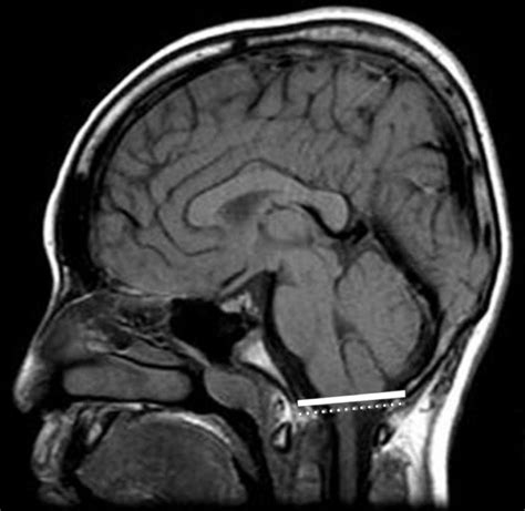 Midsagittal T1-weighted MRI of the brain shows herniation of the... | Download Scientific Diagram