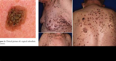 Understanding Seborrheic Keratosis (SK): Causes Symptoms And Treatments – EadvVienna2020.org