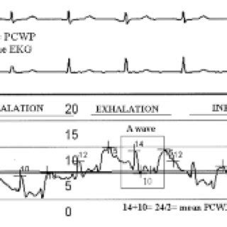 The proper timing to measure pulmonary capillary wedge pressure (PCWP ...