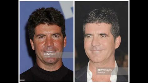 Simon Cowell Botox Injections Before and After Photos - YouTube