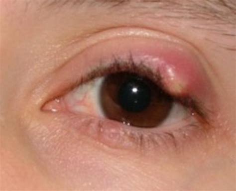 Stye Eye - Causes, Symptoms, Pictures, Treatment, Prevention | Diseases ...