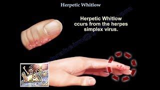 Herpes On Knuckles