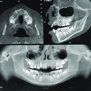 (PDF) Regional odontodysplasia: A rare case series and review