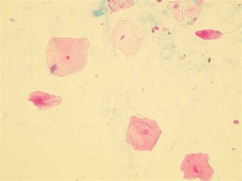 Epithelial cells in urine - what does it mean if you have epithelial cells in urine