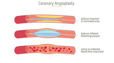 Percutaneous Transluminal Coronary Angioplasty | Qunomedical