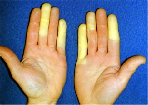 Raynaud’s disease - WikEM