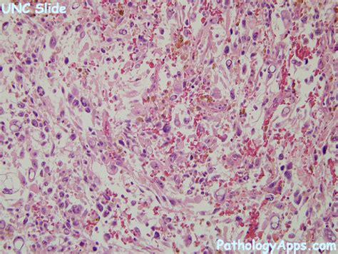 myxofibrosarcoma pathology