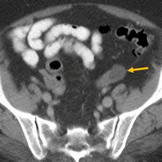 Contemporary Guidelines for Adnexal Mass Imaging: A 2020 Update | Request PDF