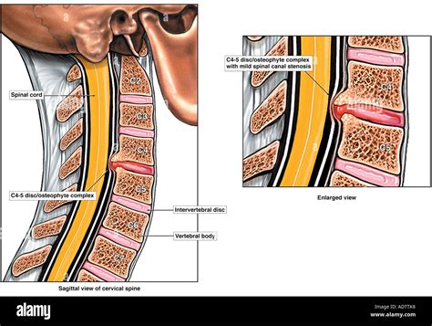 Spinal Cord Injury Cervical Subluxation Neck Vertebrae Overlap Stock ...