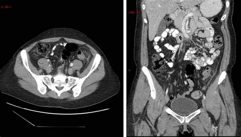 Epiploic Appendagitis