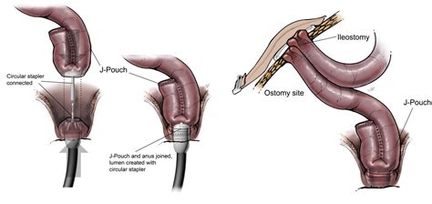 Proctocolectomy | Baylor Medicine