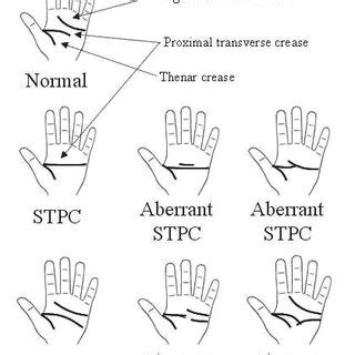 (PDF) Palmar Creases: Classification, Reliability and Relationships to Fetal Alcohol Spectrum ...