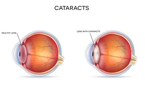 How Quickly Do Cataracts Develop