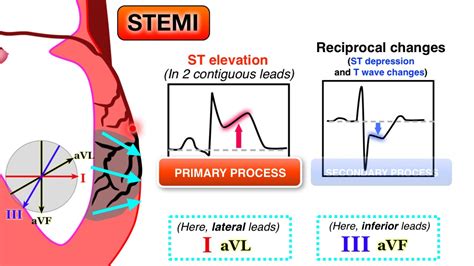 Ischemia 6/7 - STEMI on ECG - YouTube