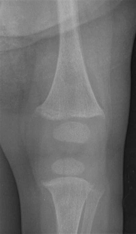 Case in Point: Hypophosphatemic Rickets | Consultant360