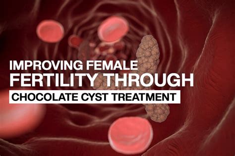 Improving Female Fertility Through Chocolate Cysts TreatmentBest IVF ...