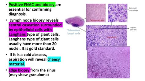 Tuberculous lymphadenitis,cervical lymphadenitis Treatment diagnosis and investigations - YouTube