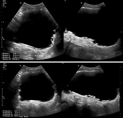 Bladder Trabeculation