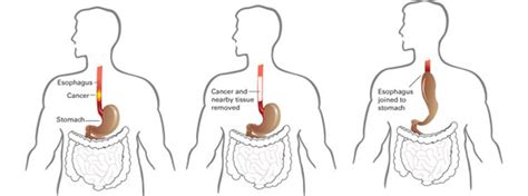 Best Esophageal Cancer Doctor in Chennai | Esophageal Cancer Treatment in Chennai