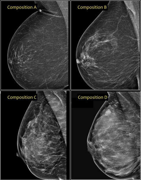 The Radiology Assistant : Bi-RADS for Mammography and Ultrasound 2013