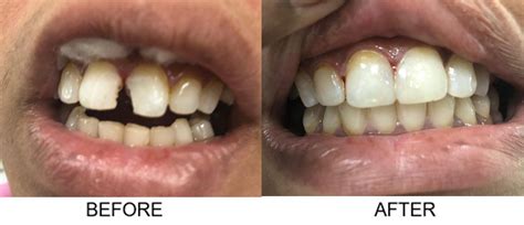 Composite Filling in Hyderabad | Best Tooth Filling in Hyderabad