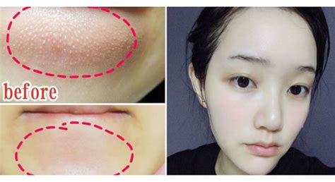 Bumps on chin: How to get rid of them?