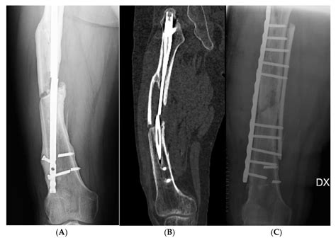 Share 142+ femur nailing recovery time best - cic32.com.vn