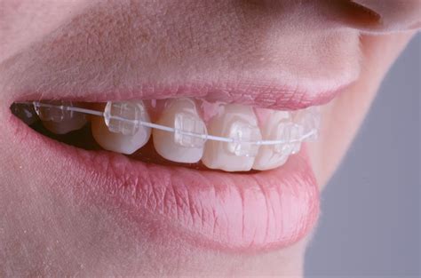 TANATAREC Orthodontics • Saphire Braces