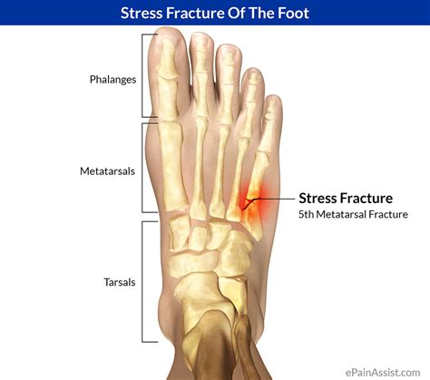 How do you know if you have a bone stress facture? | Sports Physio Massage Gold Coast | Ashmore ...