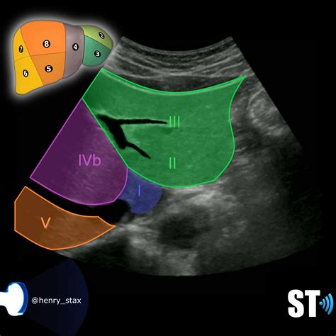 Couinaud’s Liver Segments – Sonographic Tendencies