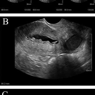 A-C. The sonohysterogram shows focal and asymmetric thickening of... | Download Scientific Diagram