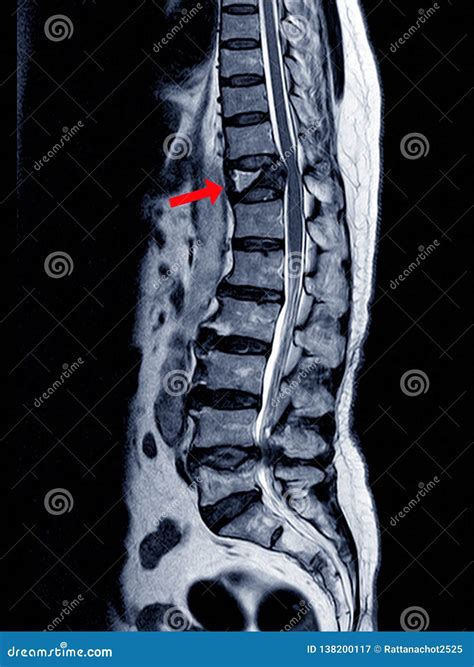 Lumbar Fracture Stock Photography | CartoonDealer.com #43419806