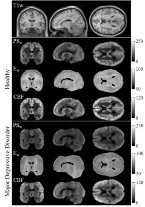 MRI illuminates causes of depression