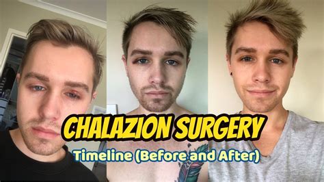 Chalazion Surgery Healing (Timeline) before and after - YouTube