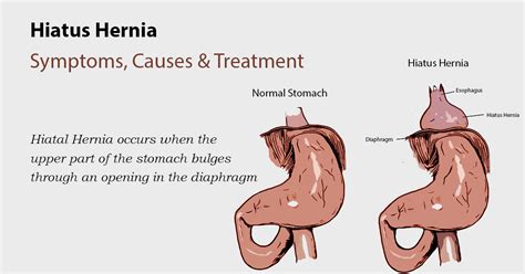 Peppermint Tea and Hiatal Hernia Surgery: What You Need to Know | Just Tea