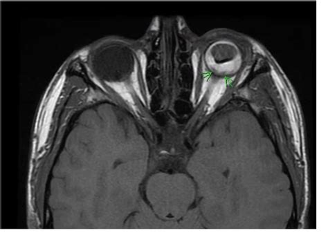 Figure 3 from MRI visualization of optic nerve avulsion due to ocular ...