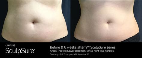 Laser Body Contouring - Before and After | SculpSure